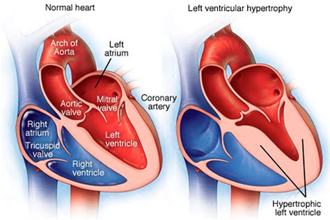 what is mild concentric lvh.